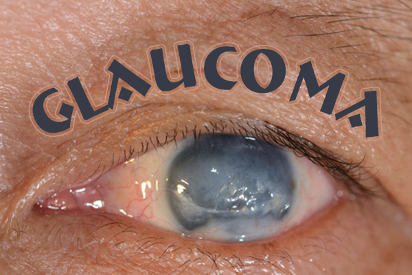 Glaucoma3